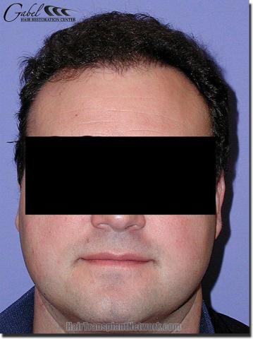 Hair restoration procedure results