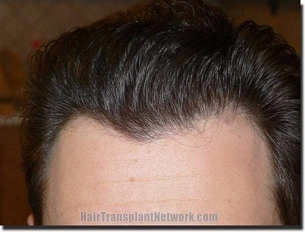 Hair restoration procedure results