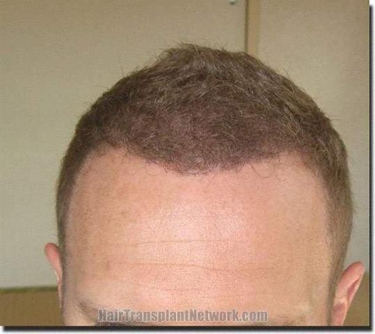 Hair restoration procedure results