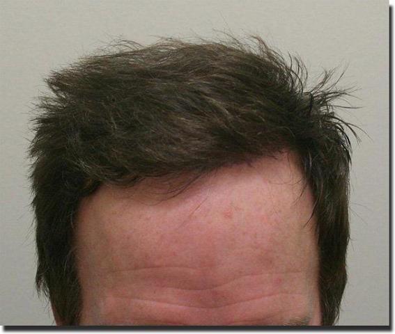 Hair restoration procedure results