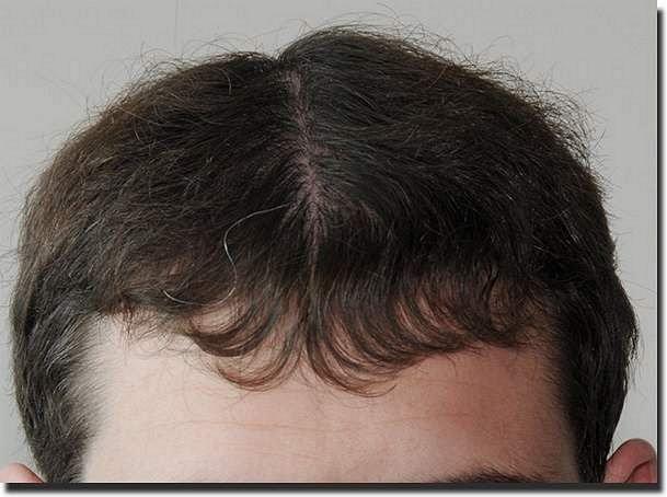 Hair restoration procedure results