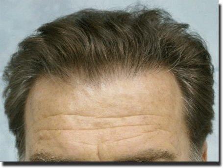 Hair restoration procedure results