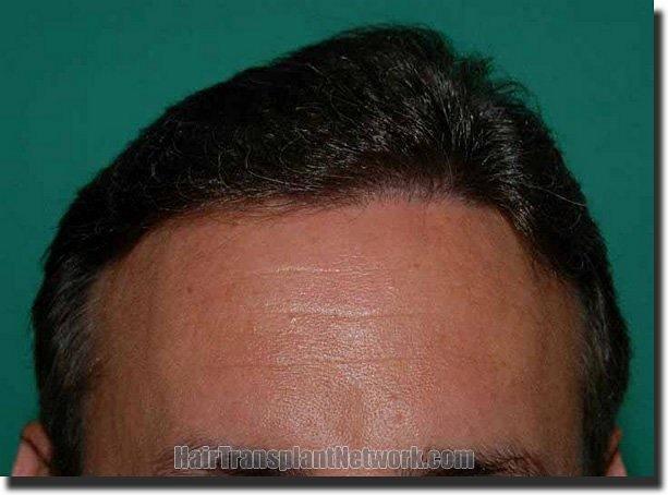 Hair restoration procedure results