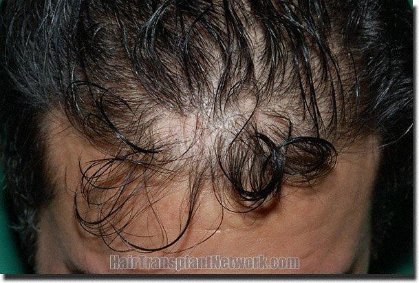 Hair restoration procedure results