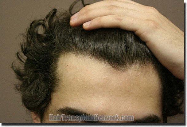 Hair restoration procedure results