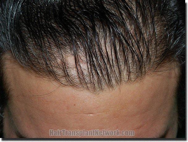 Hair restoration procedure results