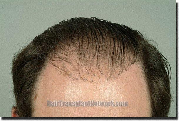 Hair restoration procedure results