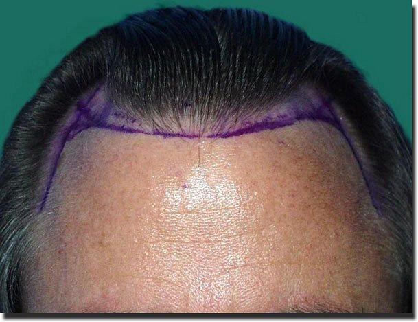 Hair restoration procedure results