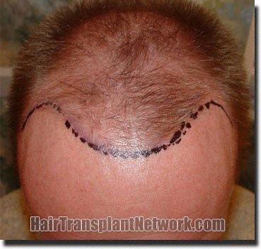 Hair restoration procedure results