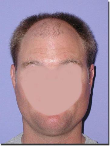 Hair restoration procedure results