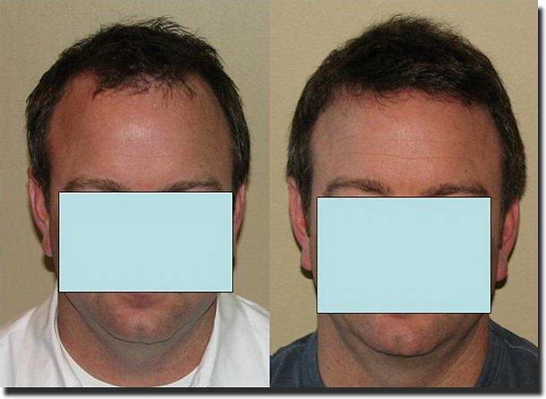 Hair restoration procedure results