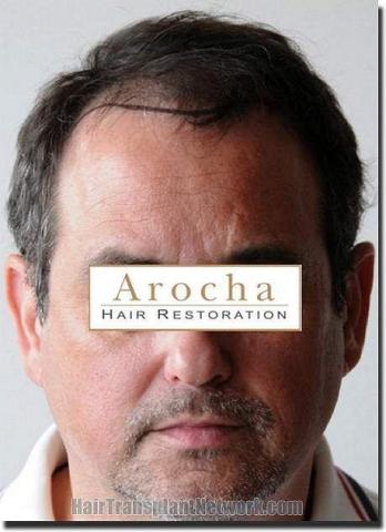 Hair restoration procedure results