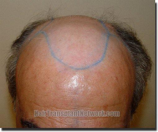 Hair restoration procedure results