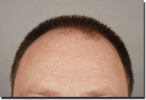 Hair restoration procedure results