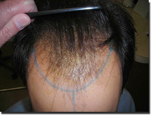 Hair restoration procedure results