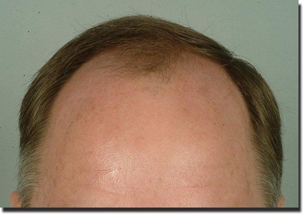 Hair restoration procedure results