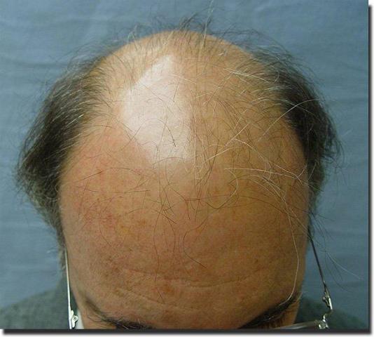 Hair restoration procedure results