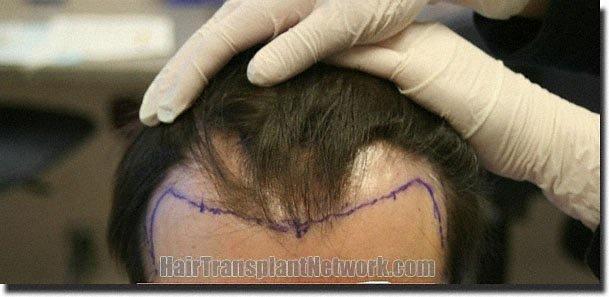 Hair restoration procedure results