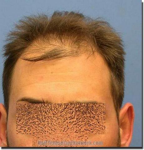 Hair restoration procedure results