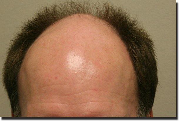 Hair restoration procedure results