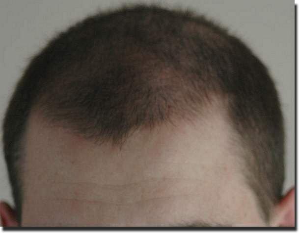 Hair restoration procedure results