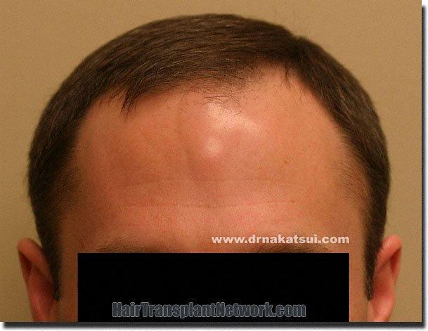 Hair restoration procedure results