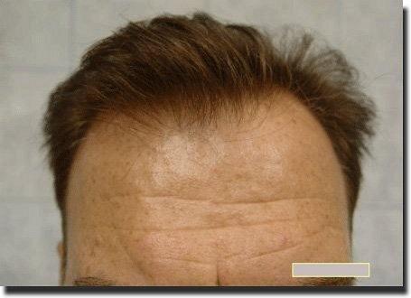 Hair restoration procedure results