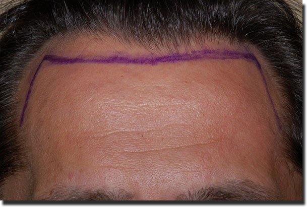 Hair restoration procedure results