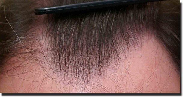 Hair restoration procedure results