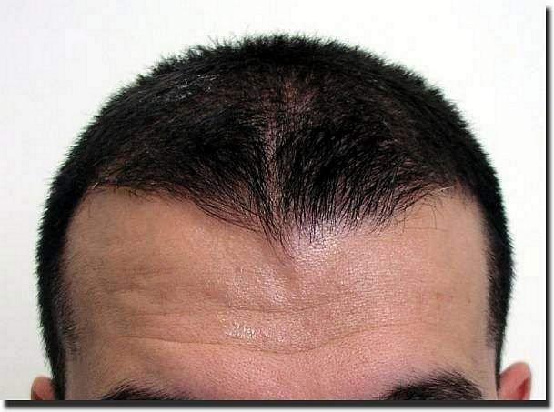 Hair restoration procedure results