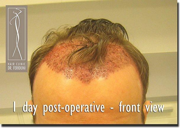 Hair restoration procedure results