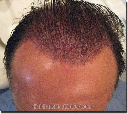 Hair restoration procedure results