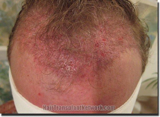 Hair restoration procedure results