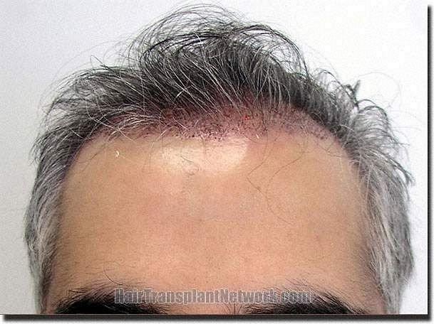 Hair restoration procedure results