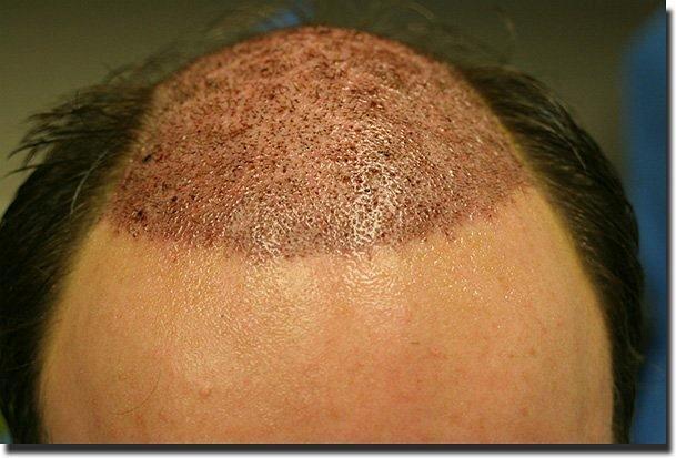 Hair restoration procedure results