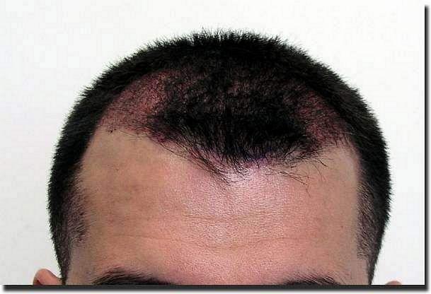 Hair restoration procedure results