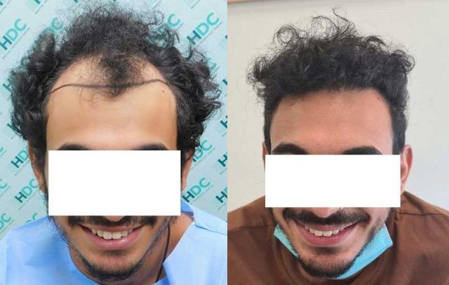 Before and after hair transplant, 3070 FUE grafts