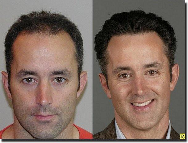 Hair restoration procedure results