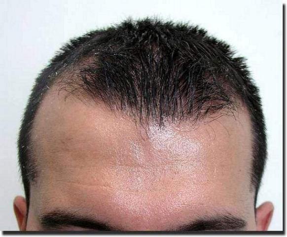 Hair restoration procedure results