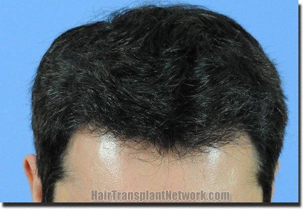 Hair restoration procedure results