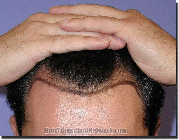 Hair restoration procedure results