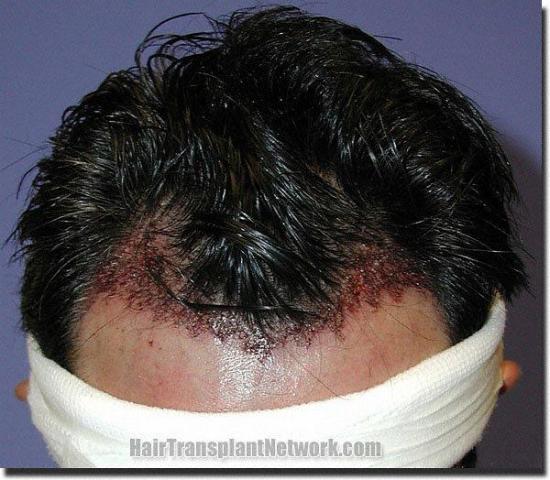 Hair restoration procedure results