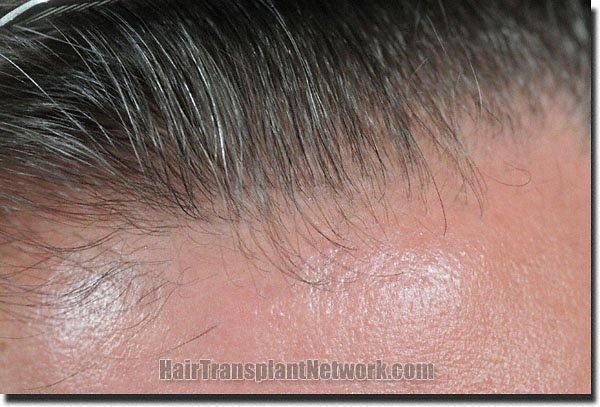 Hair restoration procedure results