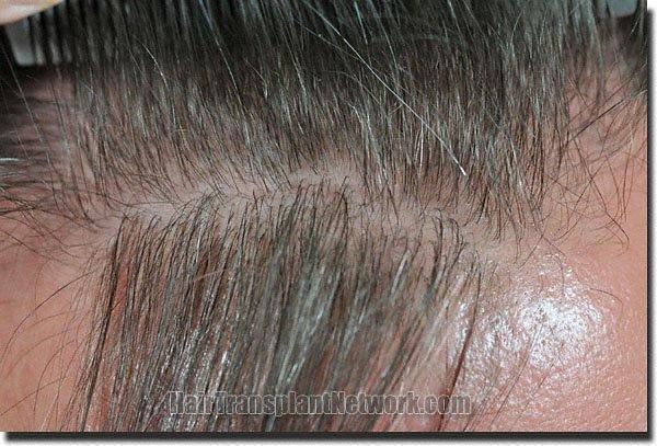 Hair restoration procedure results