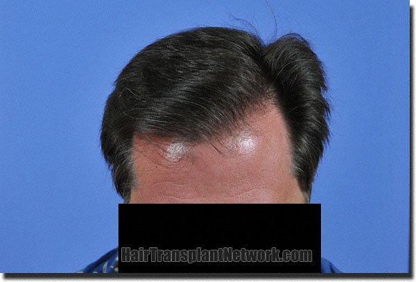 Hair restoration procedure results