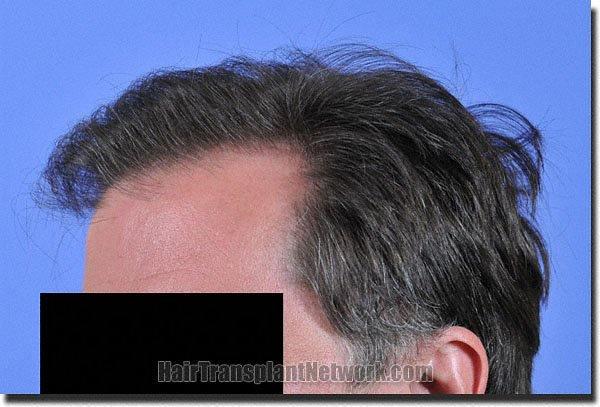 Hair restoration procedure results