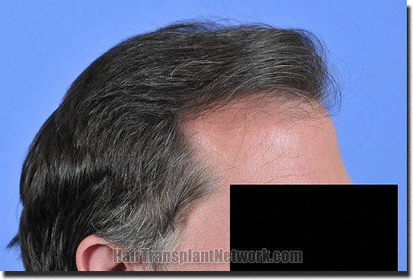 Hair restoration procedure results