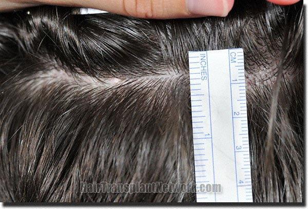 Hair restoration procedure results