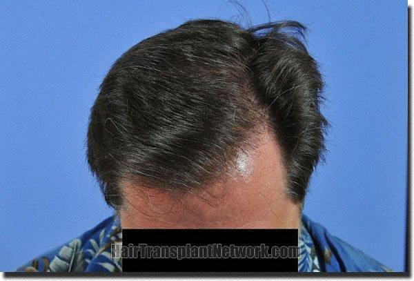 Hair restoration procedure results