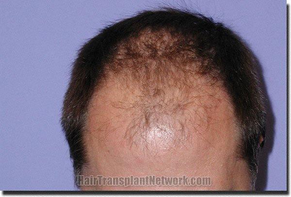 Hair restoration procedure results